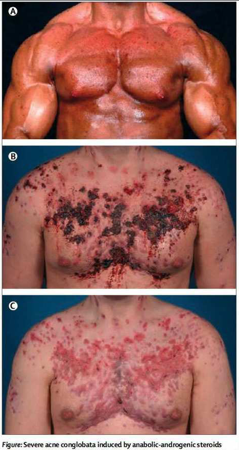 Une crise d acne impressionnante a cause de steroides
