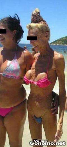 Les dangers du soleil sur la peau. Avec des faux seins c est encore pire !